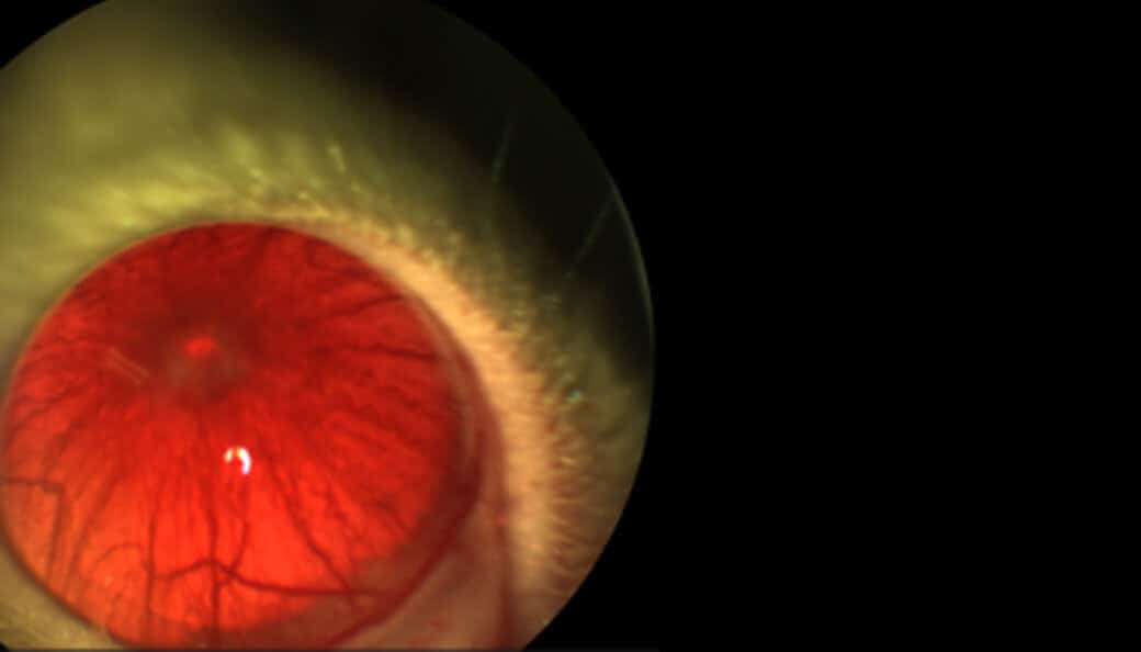 Uveitis-Eye-2 (1)